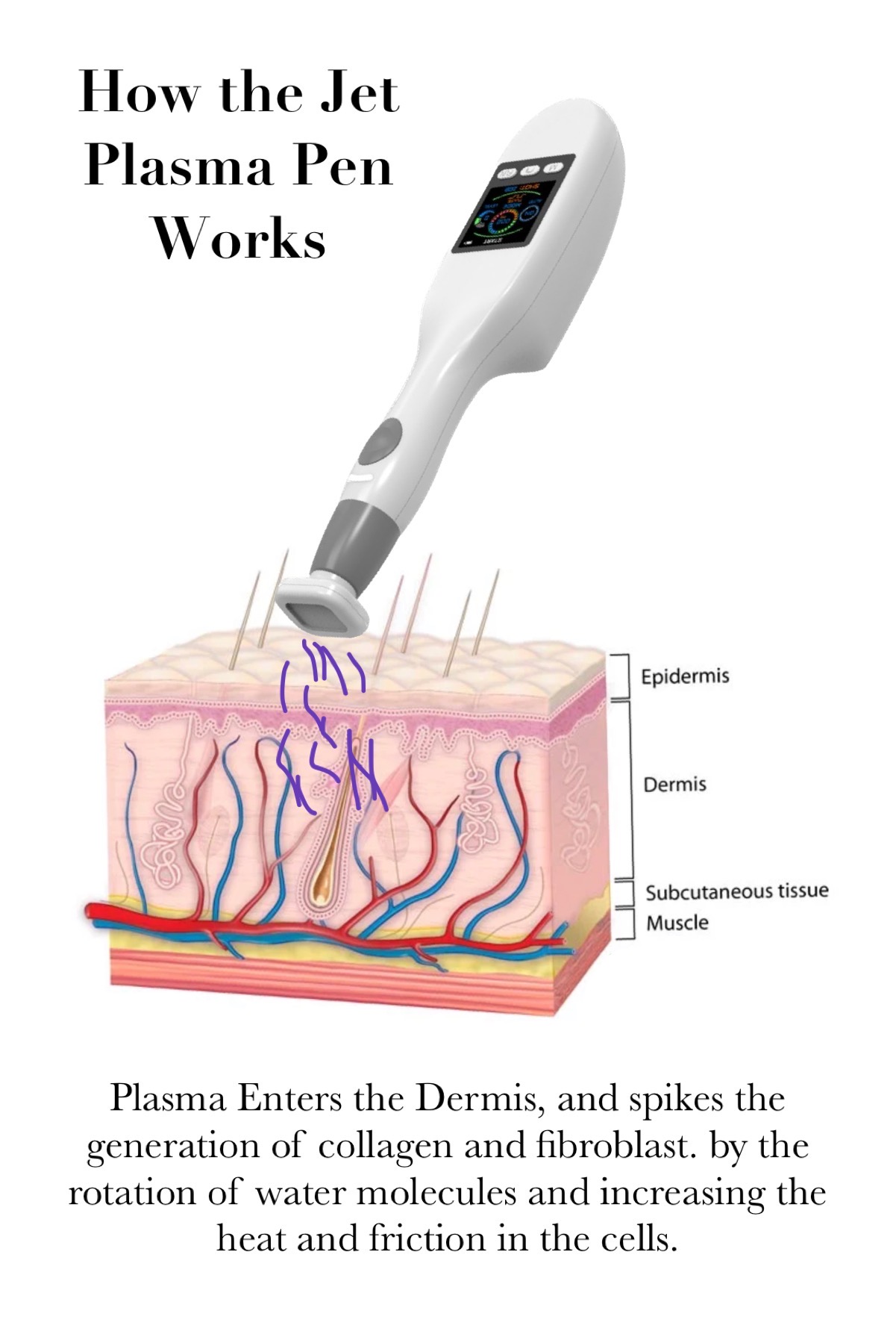 the-magic-of-jet-plasma-for-skin-care-skin-care-and-body-sculpting